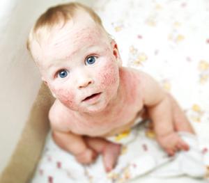 Atopic dermatitis