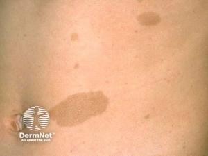 Masterclass Insights: Optimizing Care for Ulcerated Hemangiomas and Café-au-Lait Macules