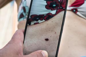 EADV Review Finds Major Safety and Transparency Gaps in Mobile AI Dermatology Apps