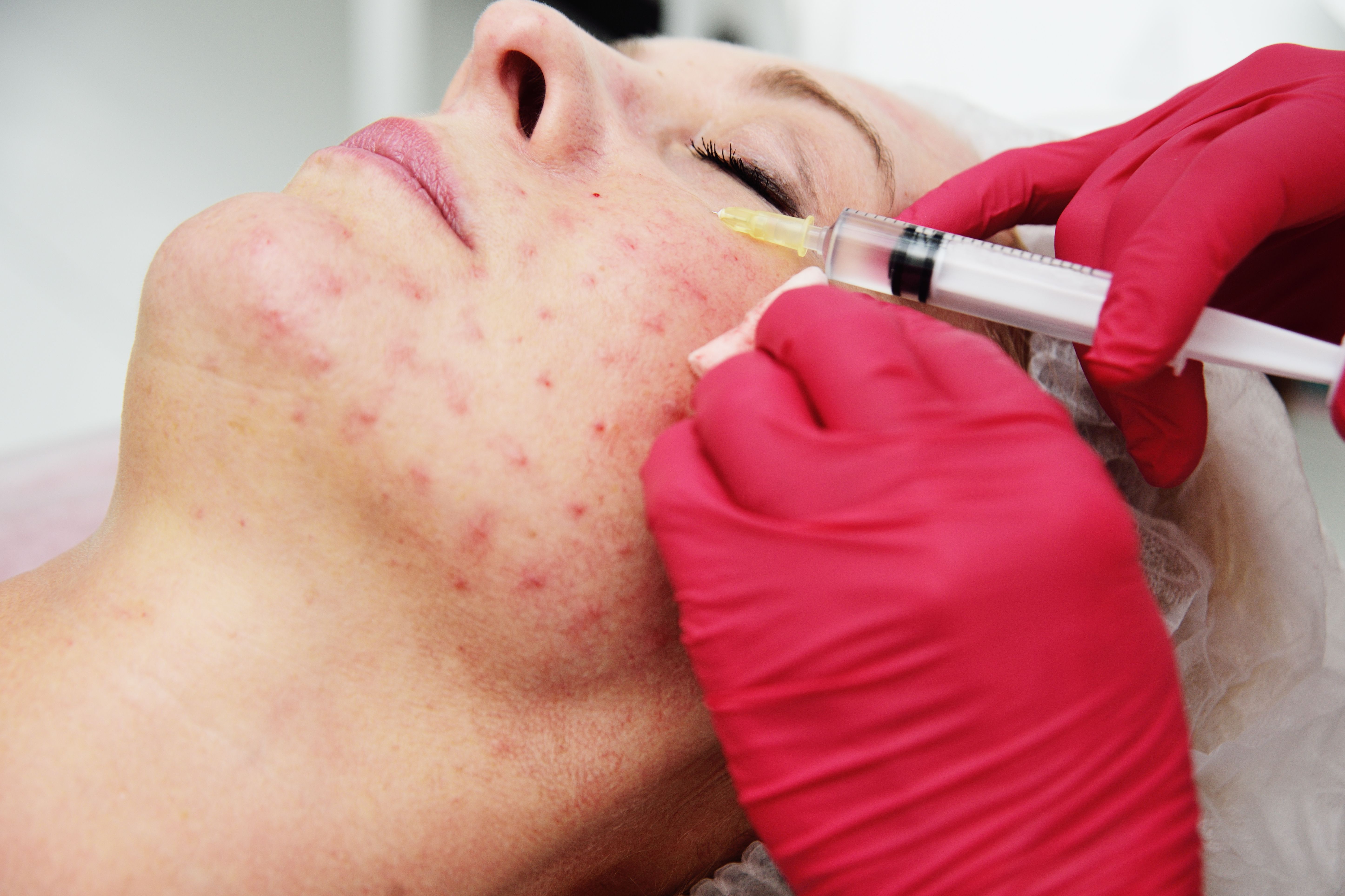 Rosacea and Menopause
