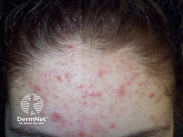 <![CDATA[Syrian Study Confirms Isotretinoin’s Effectiveness in Acne Treatment]]>