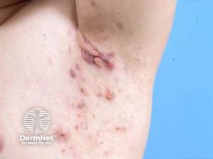 Dual IL-17A and IL-36R Blockade Demonstrates Rapid Remission in Refractory Hidradenitis Suppurativa