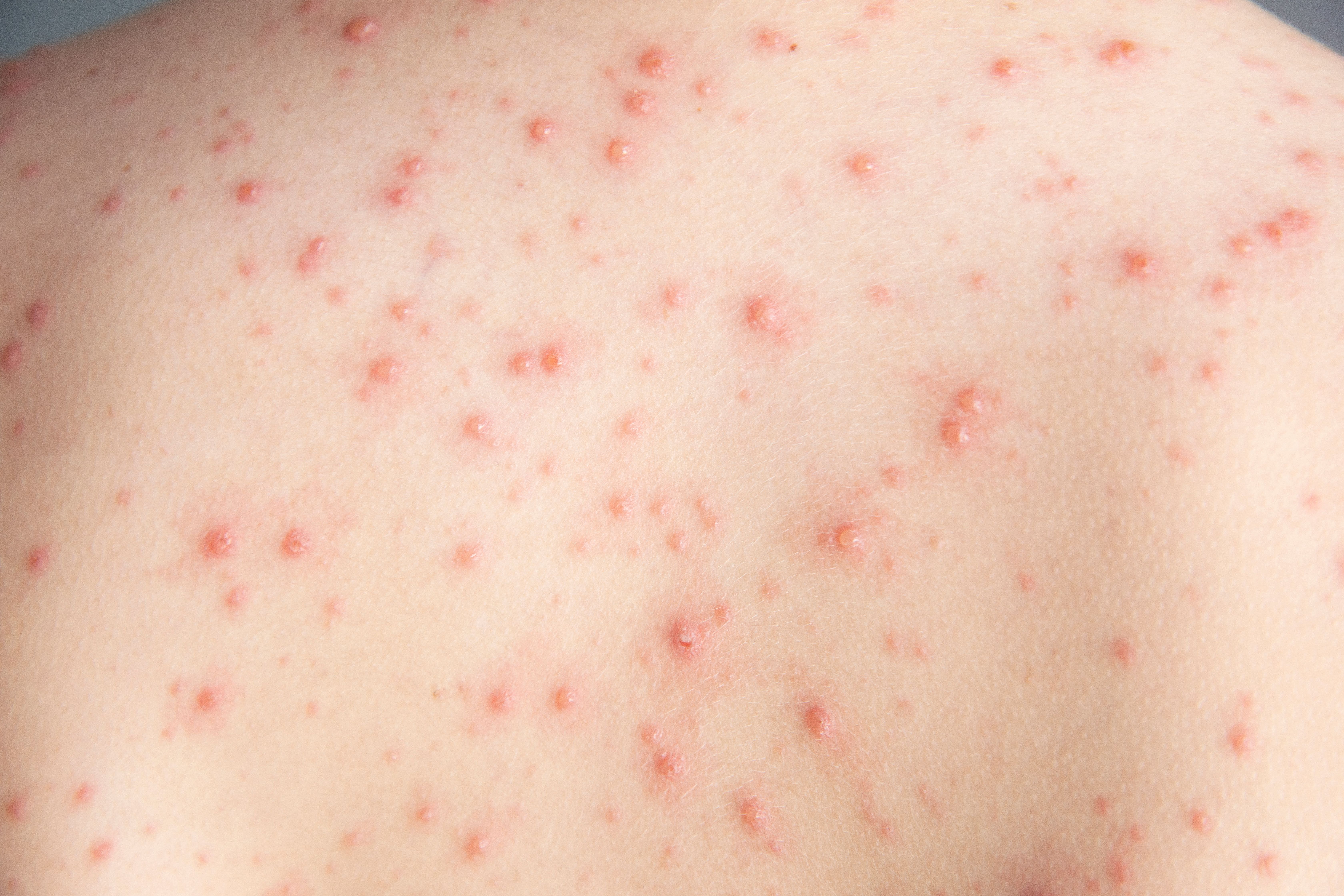 From COVID-19 to Clear Skin: How mRNA Technology May Be Used to Fight Acne