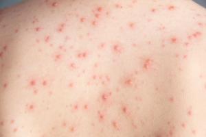 From COVID-19 to Clear Skin: How mRNA Technology May Be Used to Fight Acne