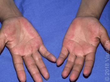 lesions on palms of hands