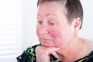 woman with rosacea