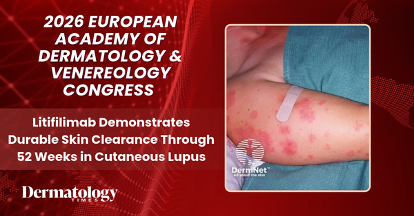 Litifilimab Demonstrates Durable Skin Clearance Through 52 Weeks in Cutaneous Lupus