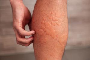 30-Year Analysis of Chronic Urticaria in the MENA Region Reveals Decades of High Burden