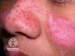 IMVT-1402 Misses Primary Endpoint in Cutaneous Lupus Proof-of-Concept Trial