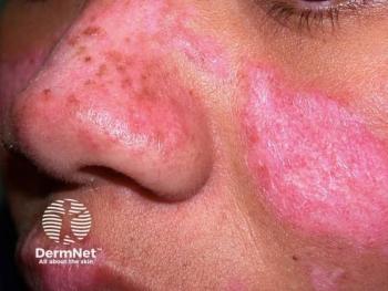 IMVT-1402 Misses Primary Endpoint in Cutaneous Lupus Proof-of-Concept Trial