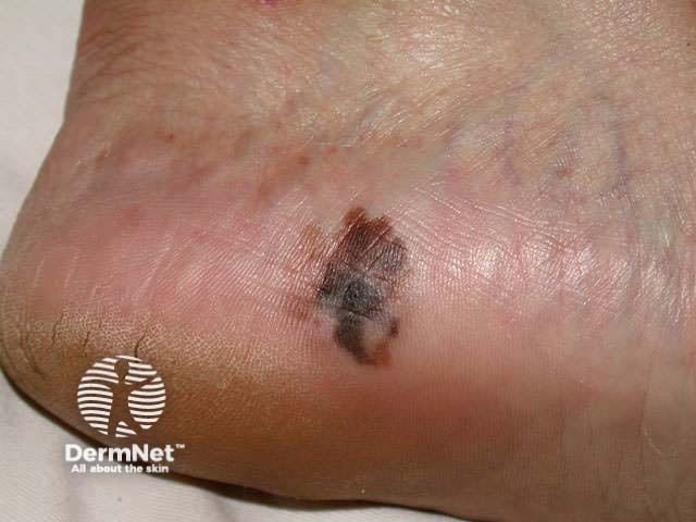 Subtype-Specific Insights into Melanoma in Iceland