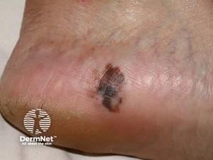 Subtype-Specific Insights into Melanoma in Iceland