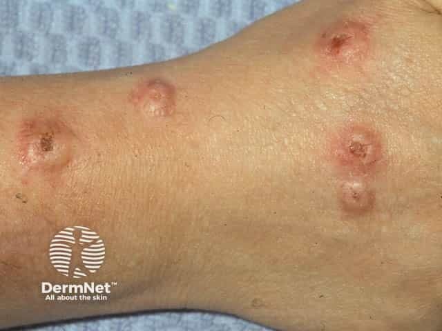 Ruxolitinib Cream Shows Promise in Prurigo Nodularis at EADV 2025