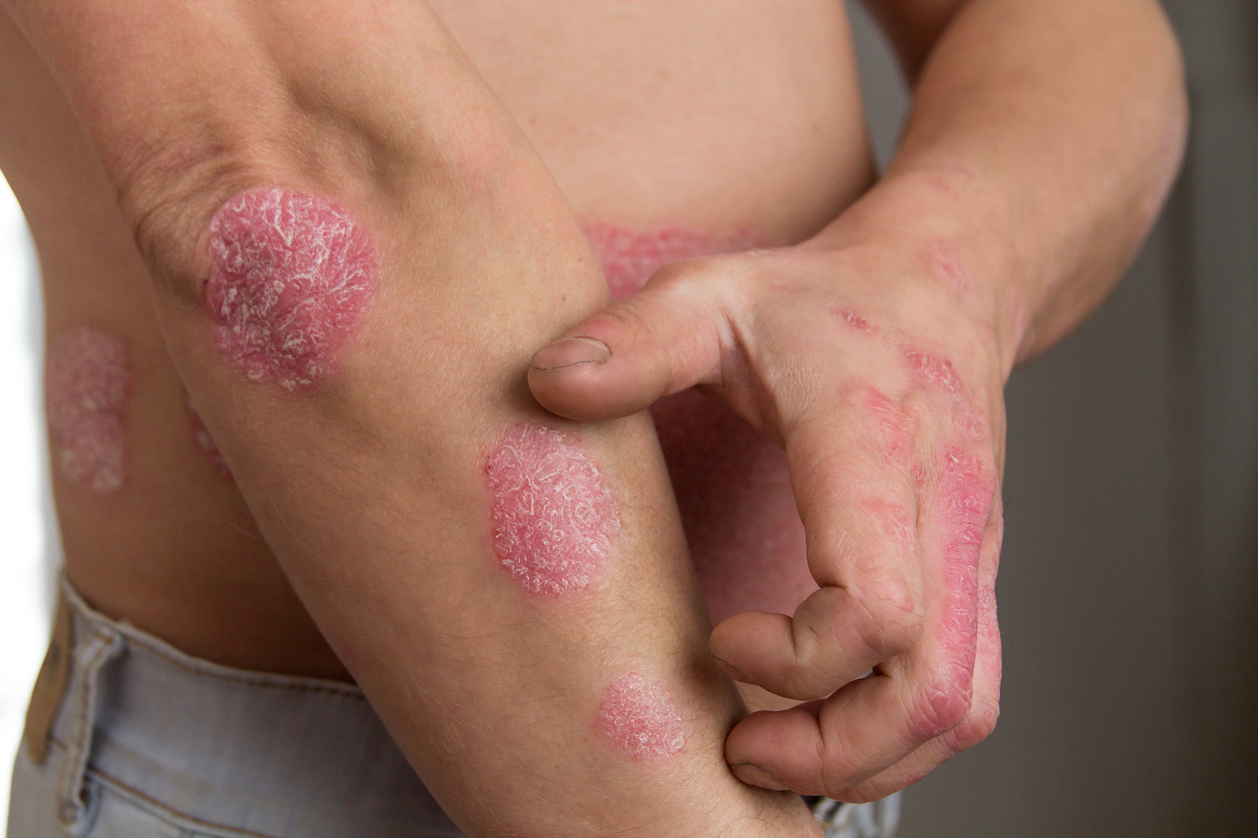 persons scratching patches or red, flaky skin (psoriasis)