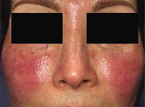 rosacea