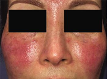 rosacea