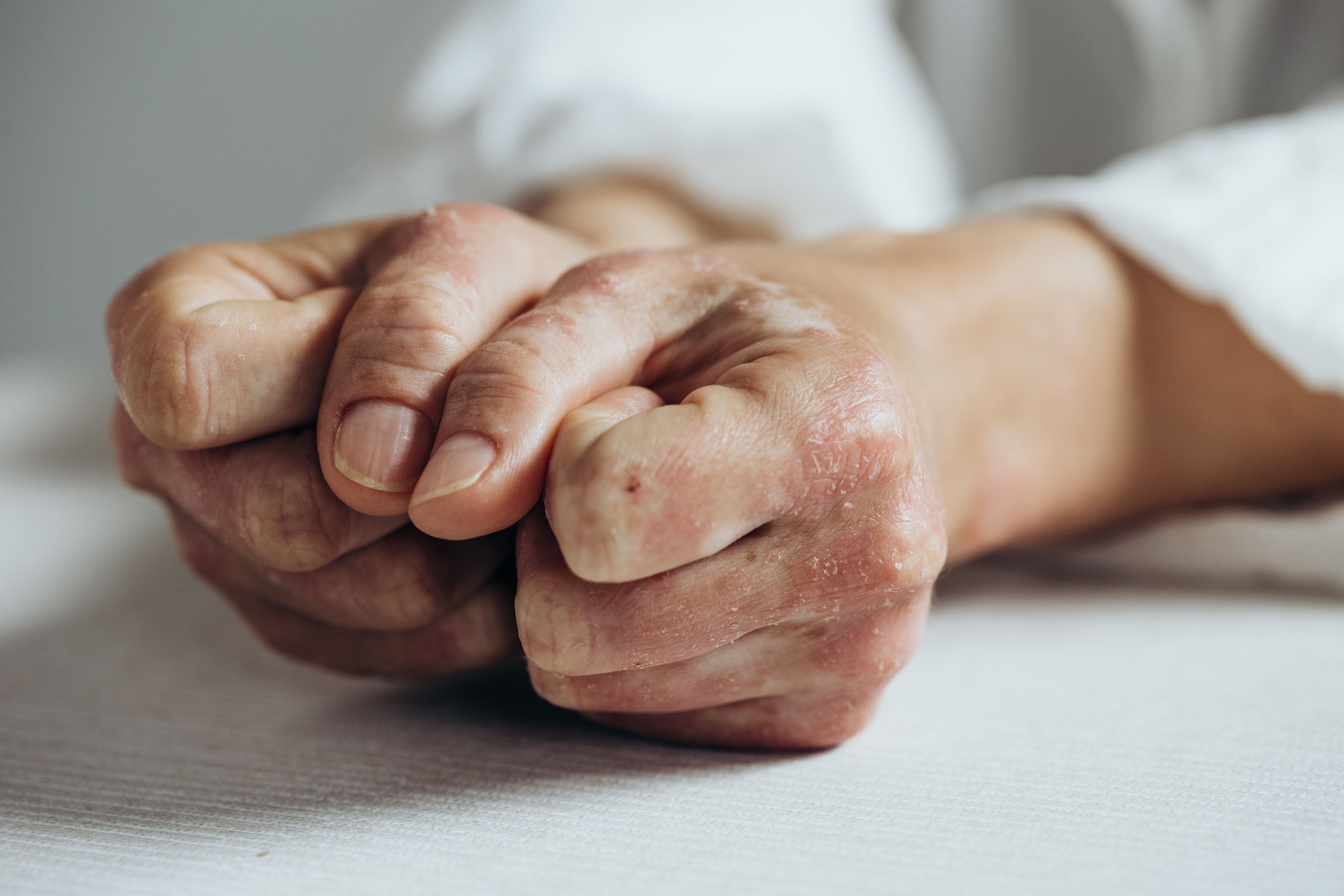Optimizing CHE Care: Evolving Strategies for Diagnosis and Management