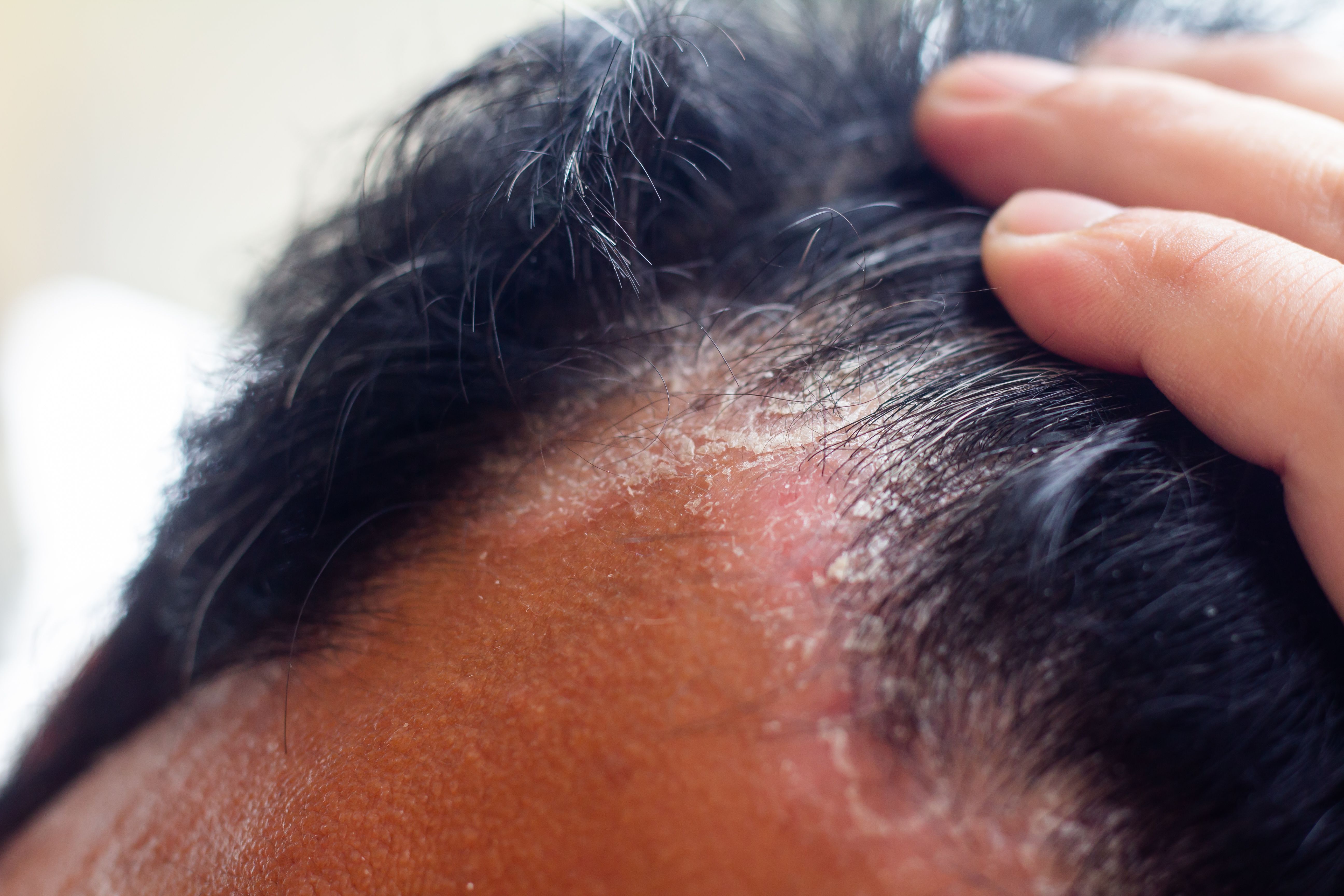 Roflumilast Foam 0.3% Demonstrates Favorable Pigmentation Profile in Seborrheic Dermatitis