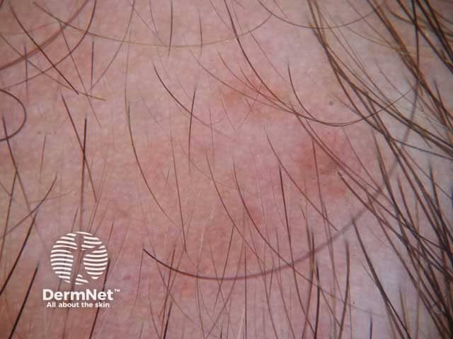 Severe Alopecia Areata Linked to Higher Atopic Dermatitis Risk
