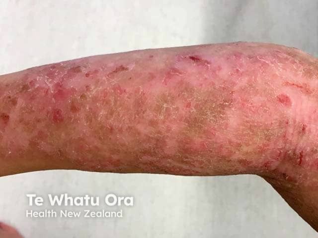 REZOLVE-AD Trial Results Show Promise for Rezpegaldesleukin in Atopic Dermatitis 