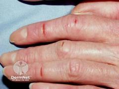EP. 3 Addressing Pain, Function, and Flares in Chronic Hand Eczema