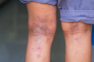 Rezpegaldesleukin Shows Deepening Response and Long-Term Durability in 52-Week AD Trial