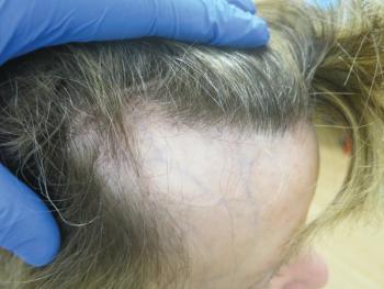frontal fibrosing alopecia
