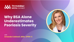 Why BSA Alone Underestimates Psoriasis Severity