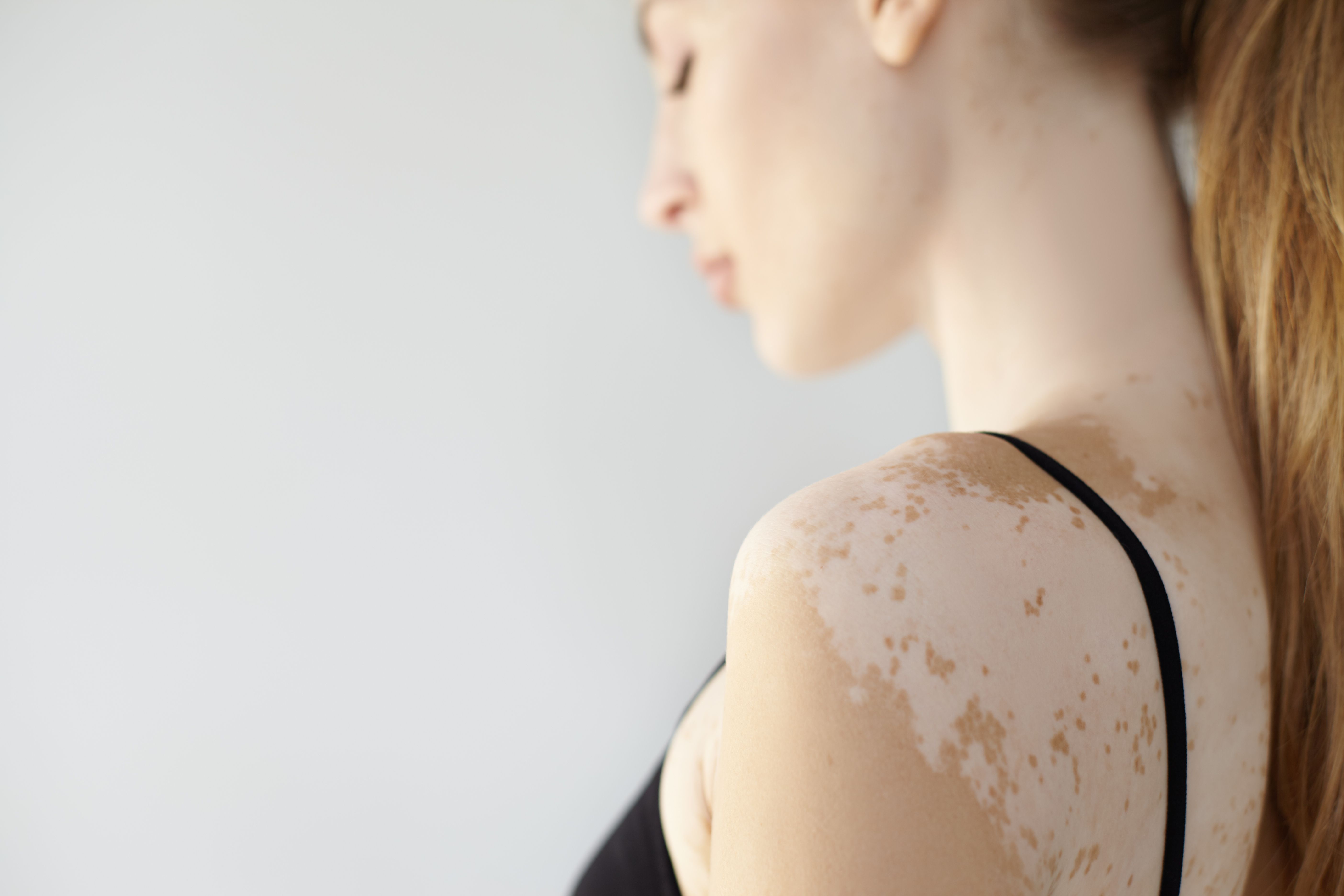 Regenerative Medicine Proves to Be Effective for Vitiligo Treatment