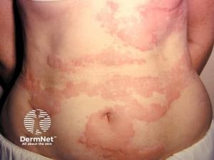 Cracking the Code of Chronic Spontaneous Urticaria: Evolving Care by Allergists and Dermatologists