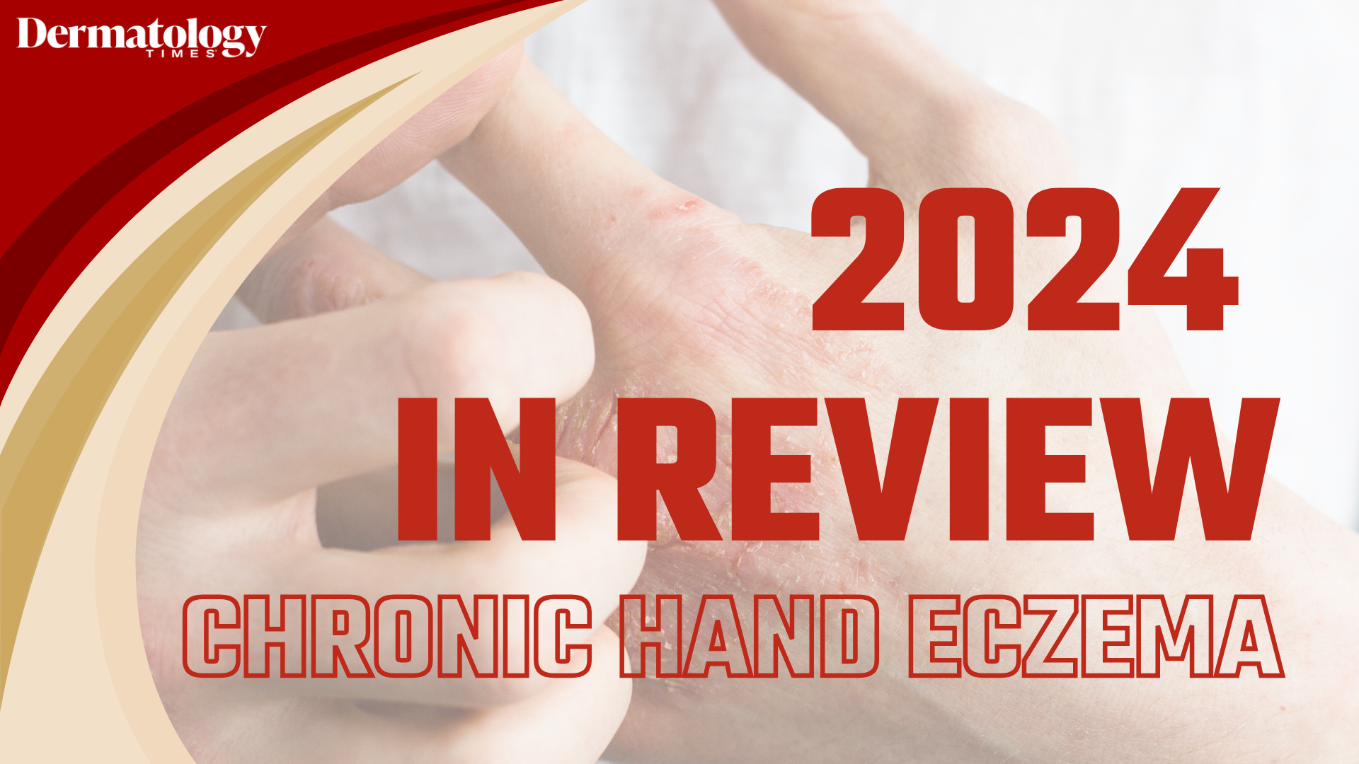 Dermatology Times 2024 in Review: Chronic Hand Eczema