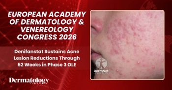Denifanstat Sustains Acne Lesion Reductions Through 52 Weeks in Phase 3 OLE