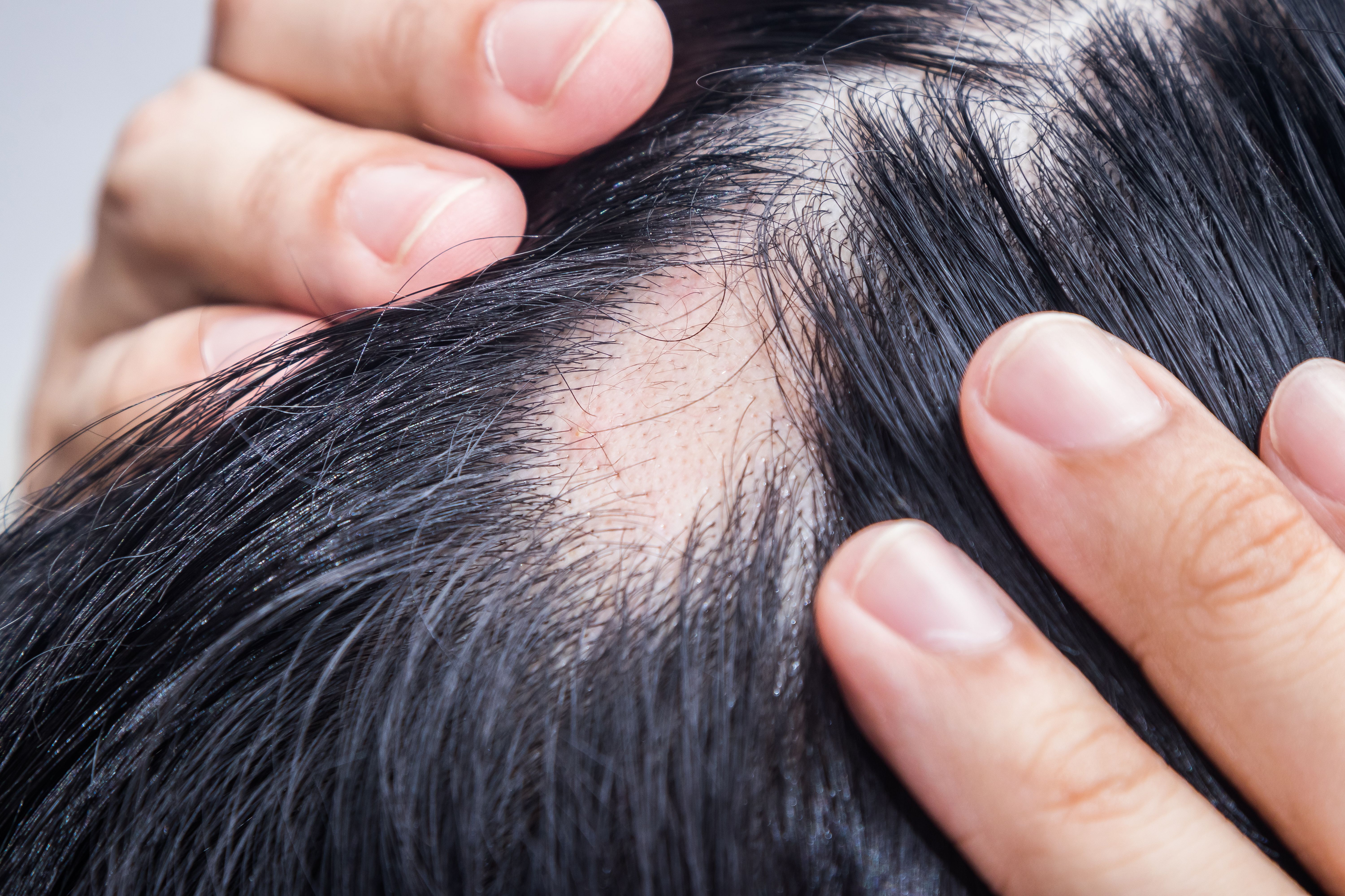 Baricitinib Shows Superior Efficacy Versus Traditional Alopecia Treatments