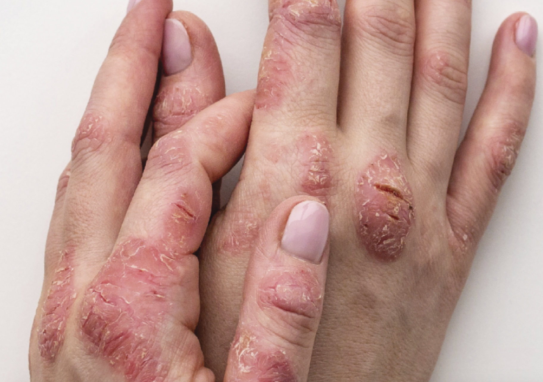 State-of-the-State Update: Chronic Hand Eczema