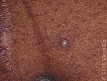 pustule on leg