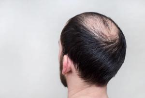 Game-Changers Advance Hair Loss Treatment