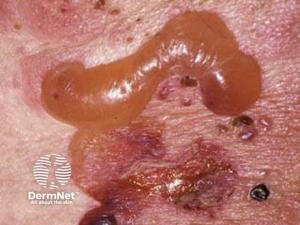 Upadacitinib Induces Long-Term Remission in Refractory Bullous Pemphigoid: A Case Report