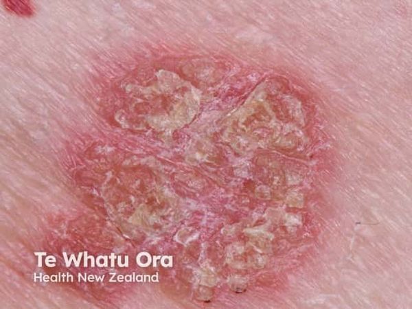 Roflumilast Eases Sexual Difficulties in Psoriasis With Genital Involvement