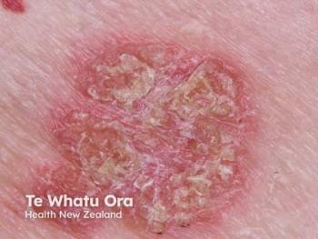 Roflumilast Eases Sexual Difficulties in Psoriasis With Genital Involvement