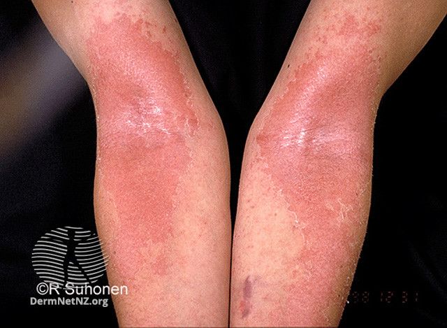 Dpar Rash Skin Long-Term Safety of Dupilumab in Adults with Moderate to Severe Atopic ...