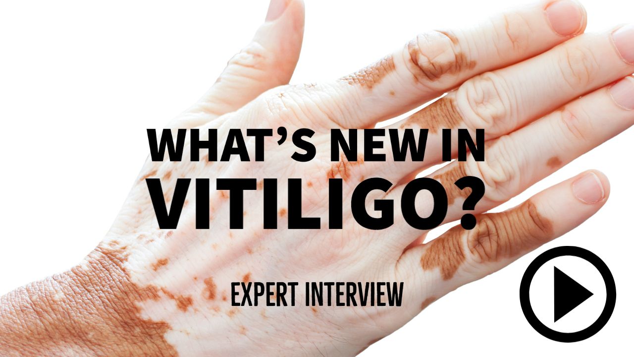 What’s new in vitiligo treatment?