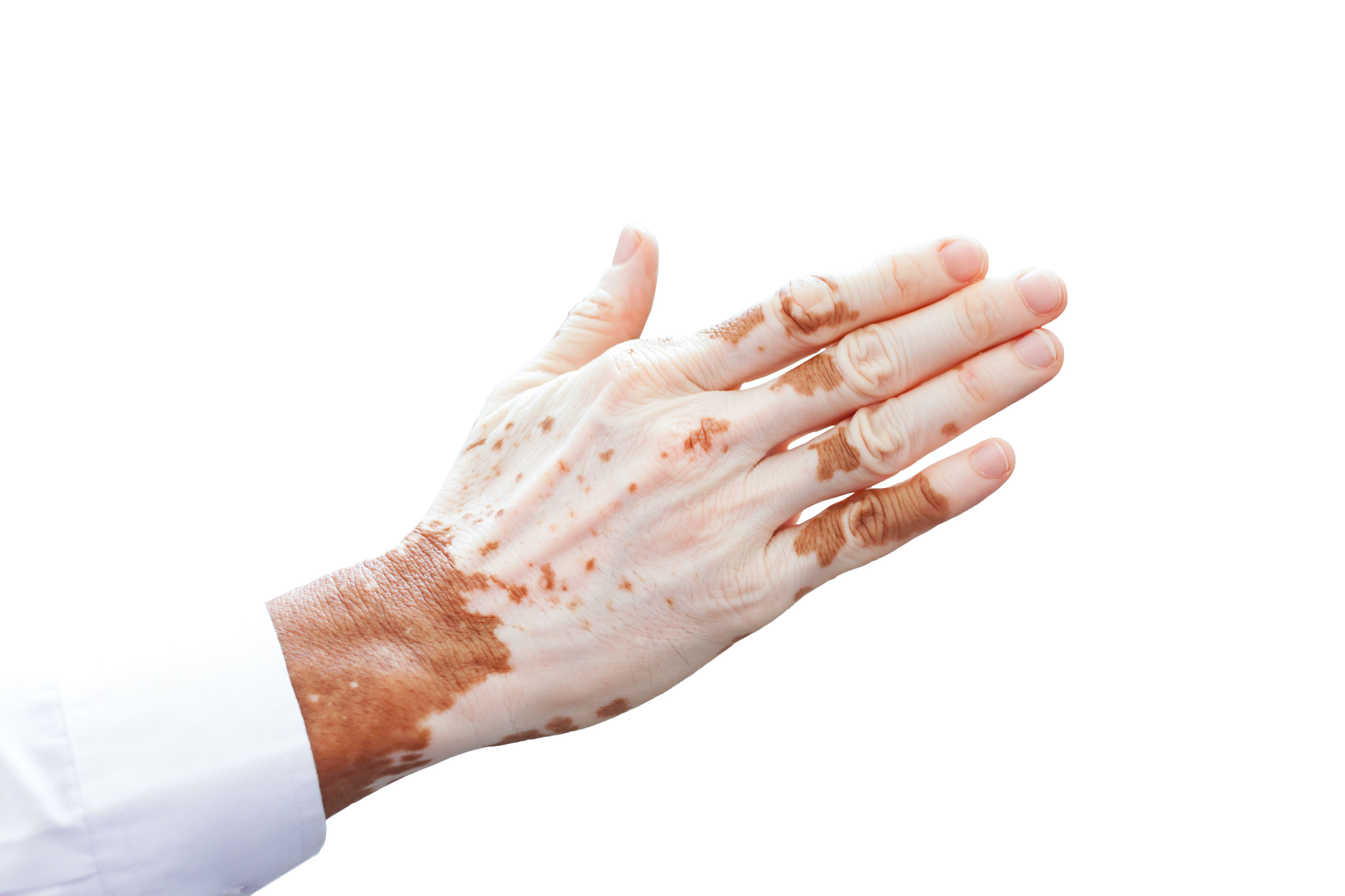 Vitiligo