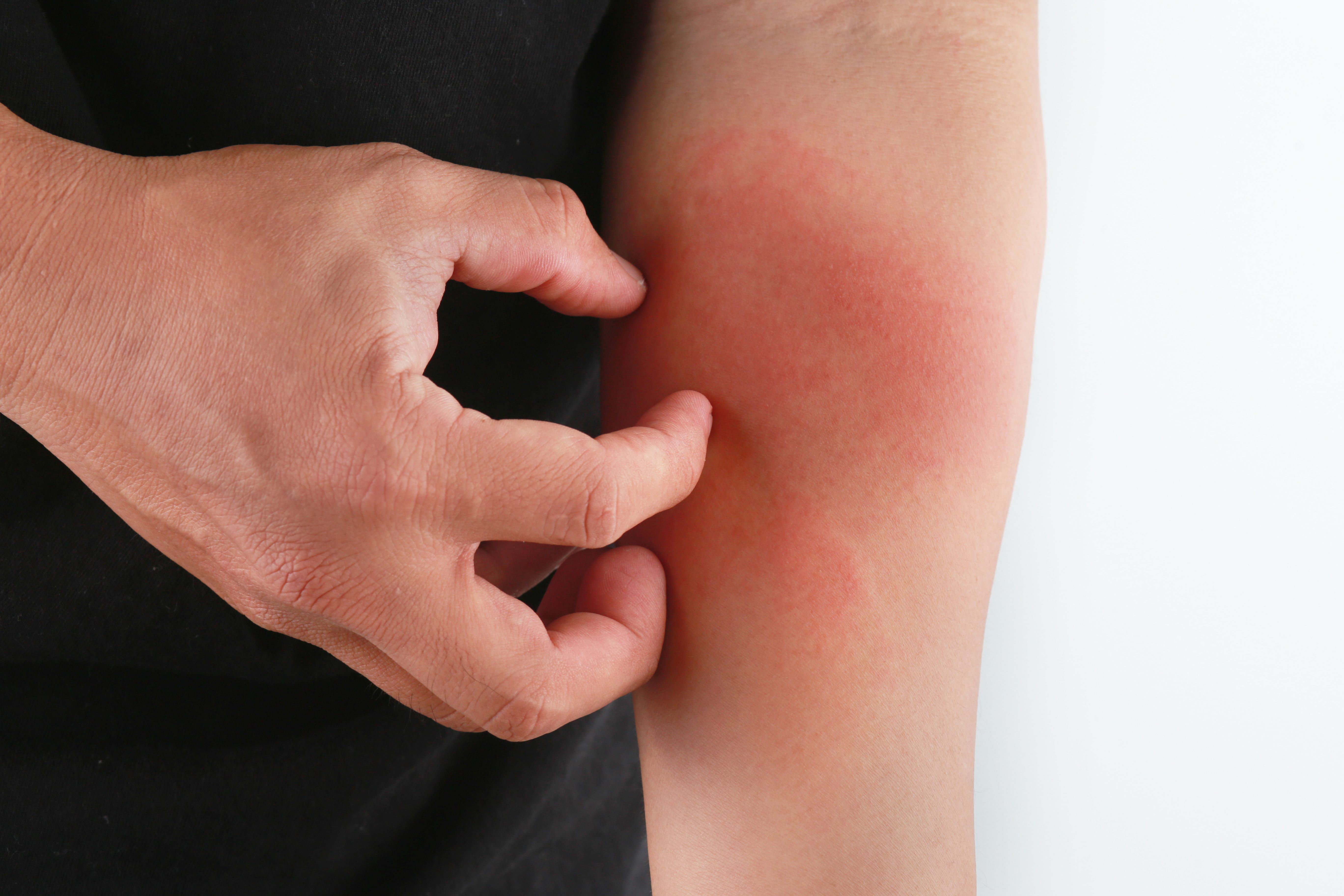 Targeted Solutions Simplify Widespread Itch Care 