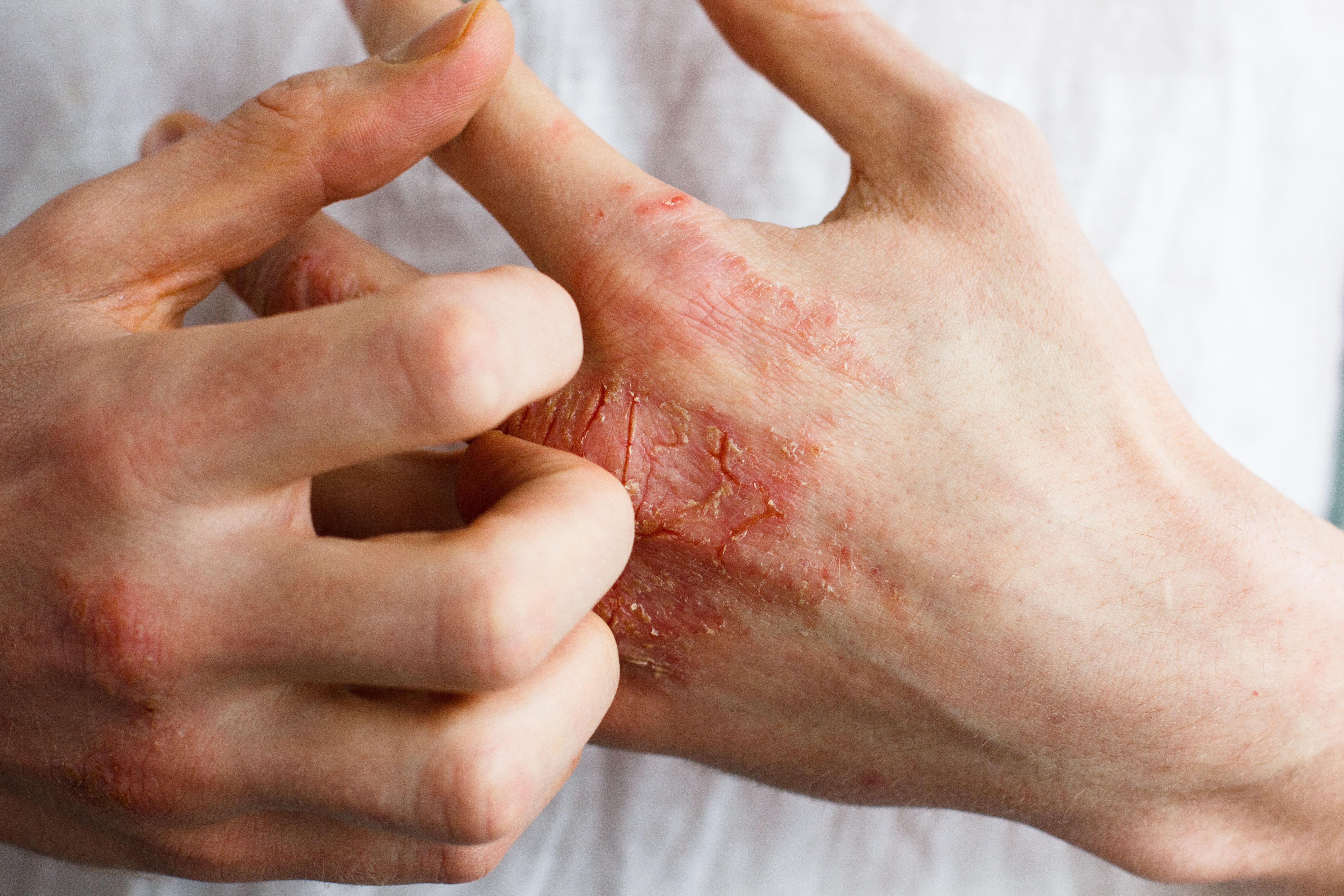 How do you tell the difference between eczema and skin cancer?