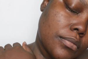 Hyperpigmentation Advice on TikTok: Reliable or Risky?