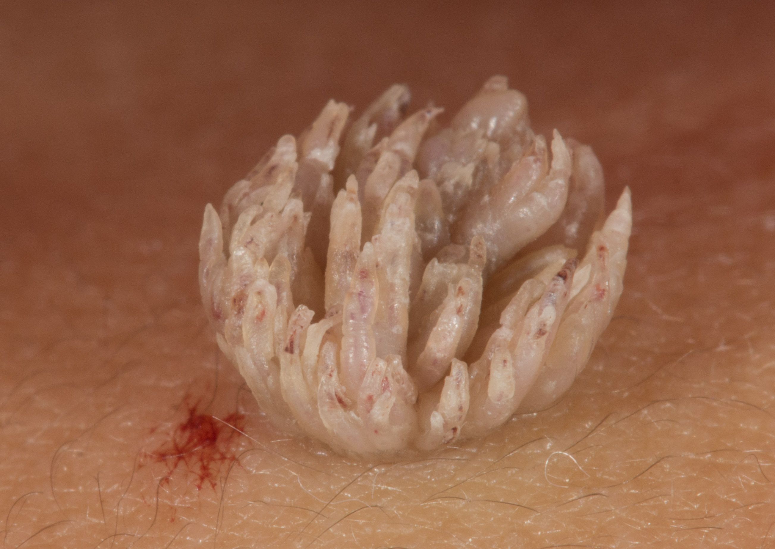 filiform wart on neck