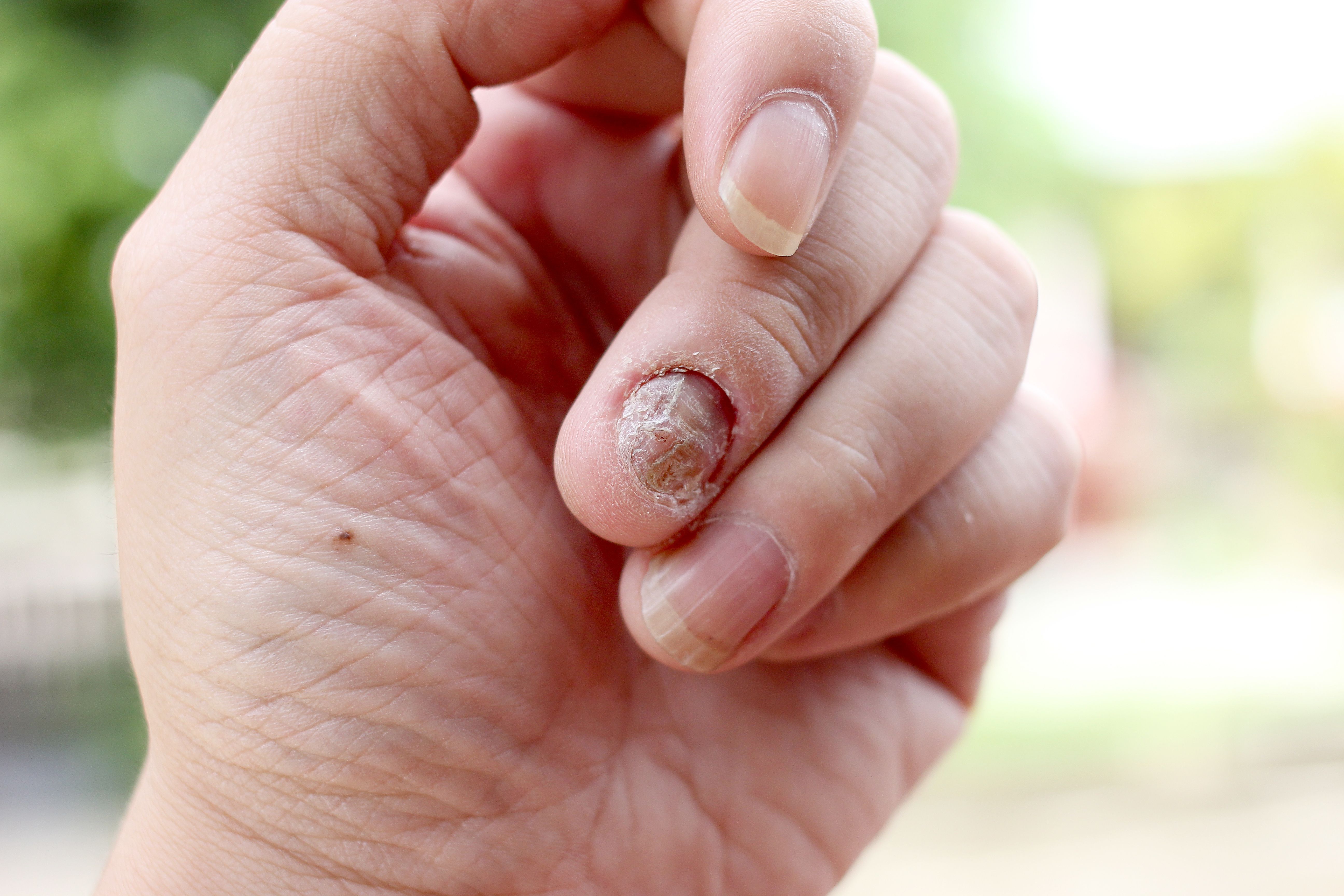 From Pixels to Precision: How Deep Neural Networks Are Enhancing Nail Disease Care