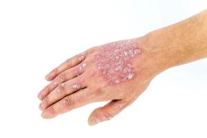 Transcriptomics May Help Revolutionize Psoriasis Treatment Using Precision Medicine