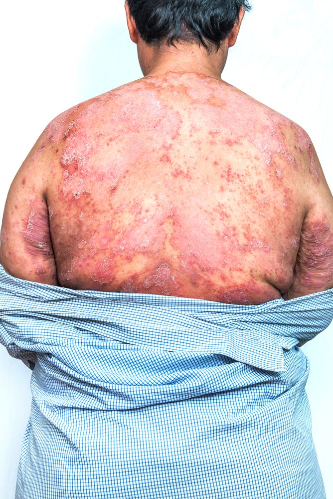 Psoriasis on back