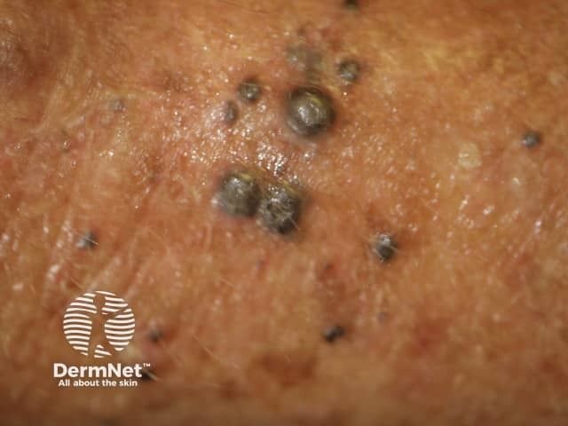 Vidutolimod Combo Therapy Shows Promise in Treating Advanced Melanoma